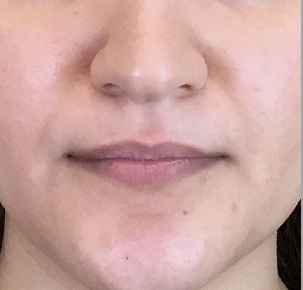 Lip Injections Case 1 Before Image