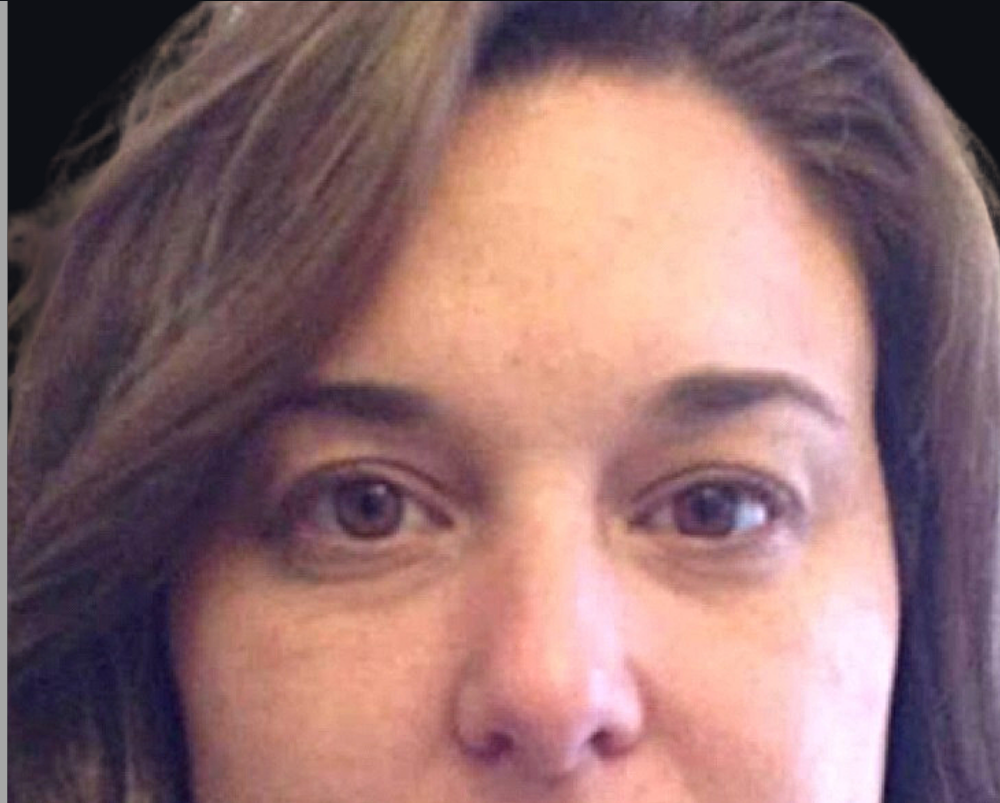 Botox® / Dysport® Case 1 After Image
