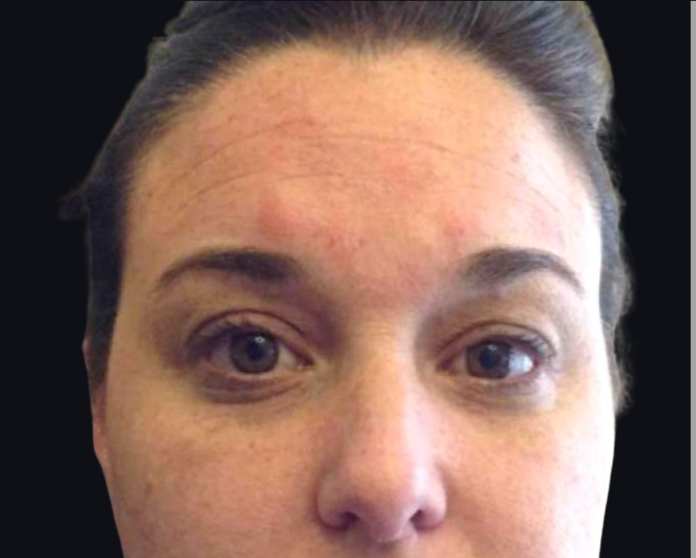 Botox® / Dysport® Case 1 Before Image