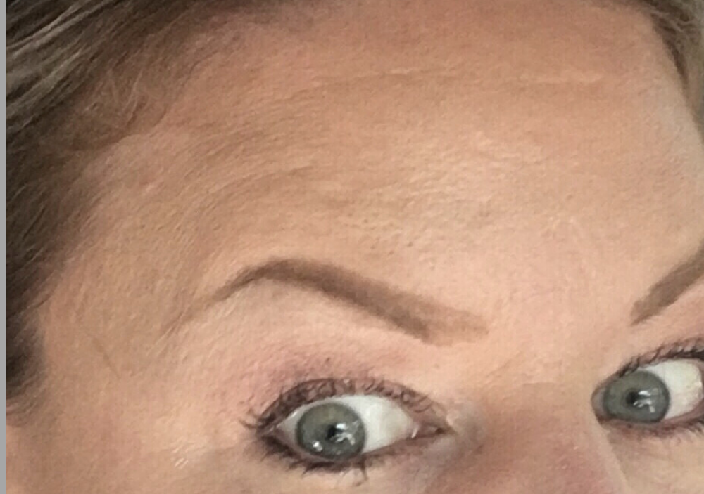 Botox® / Dysport® Case 10 After Image