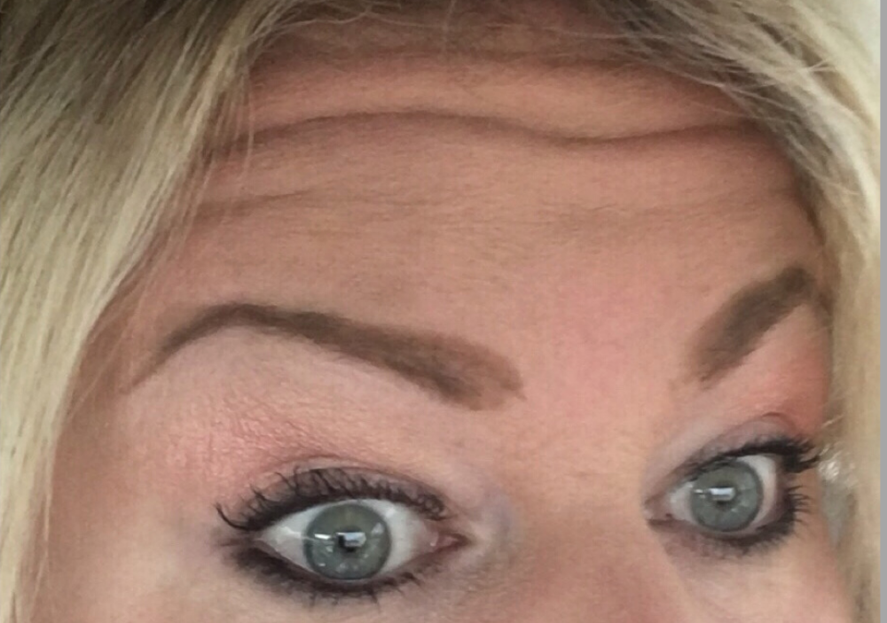 Botox® / Dysport® Case 10 Before Image