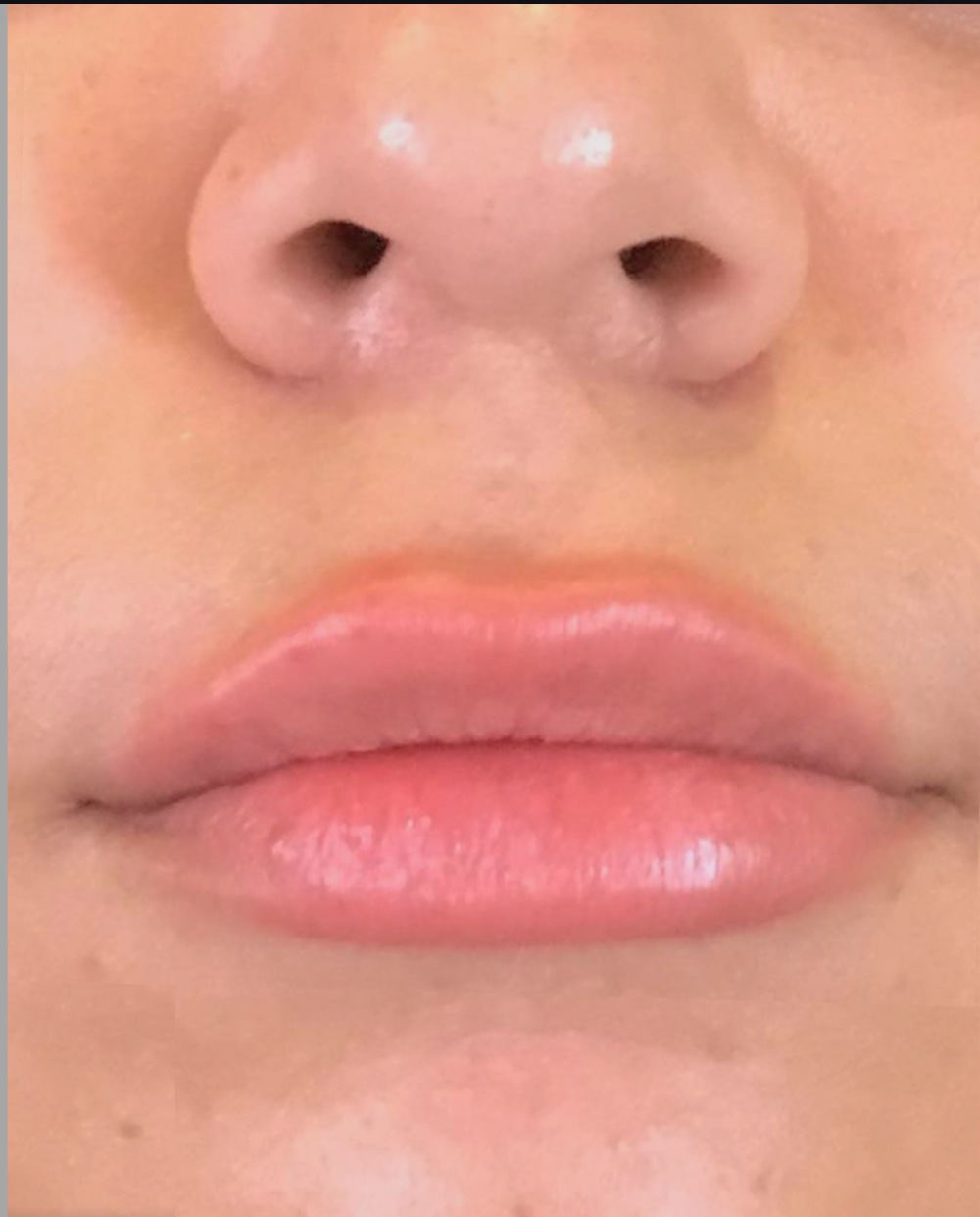 Lip Injections Case 10 After Image