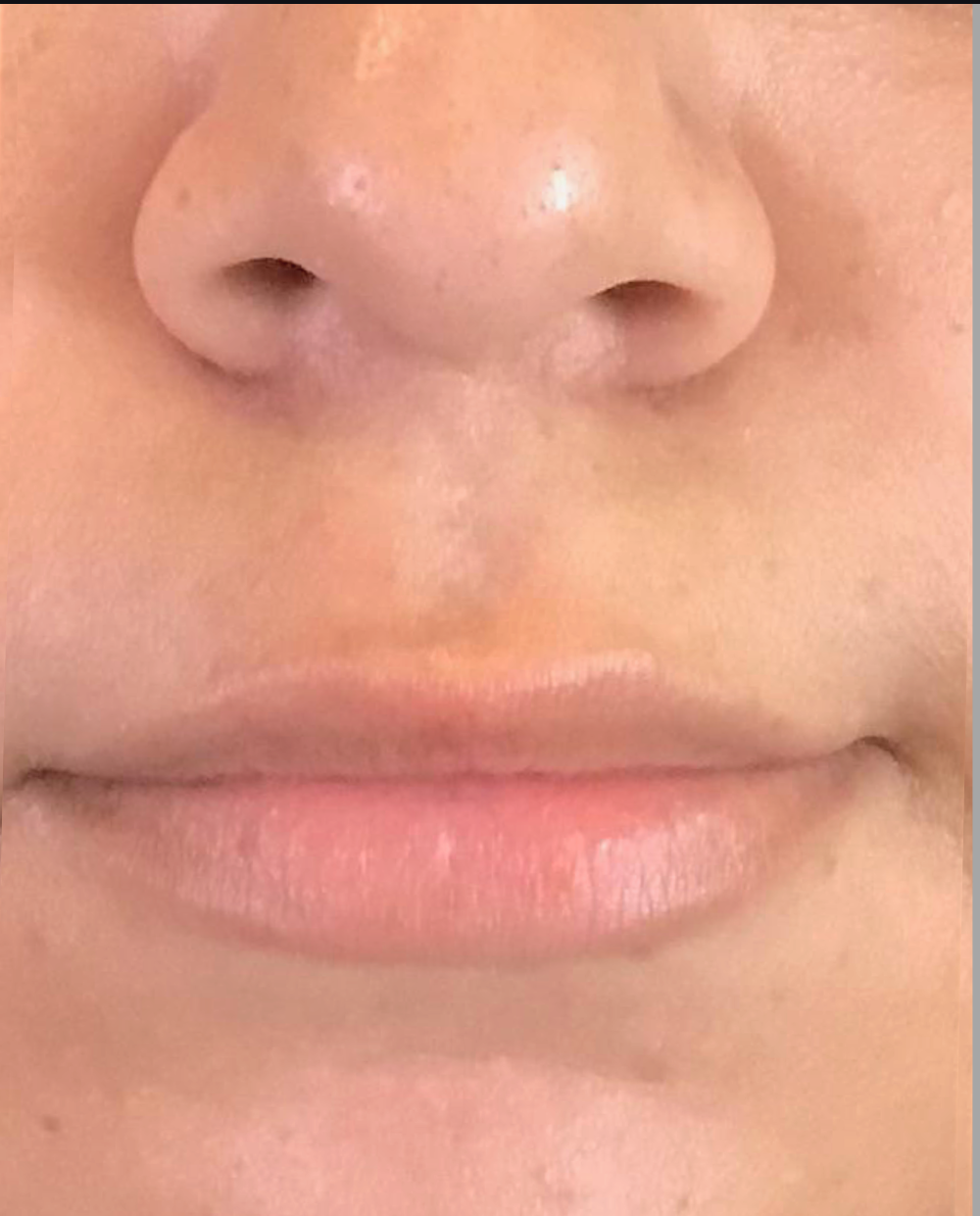 Lip Injections Case 10 Before Image