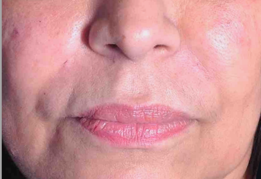 Dermal Fillers Case 11 After Image