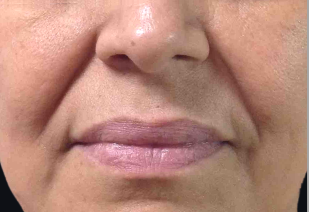 Dermal Fillers Case 11 Before Image