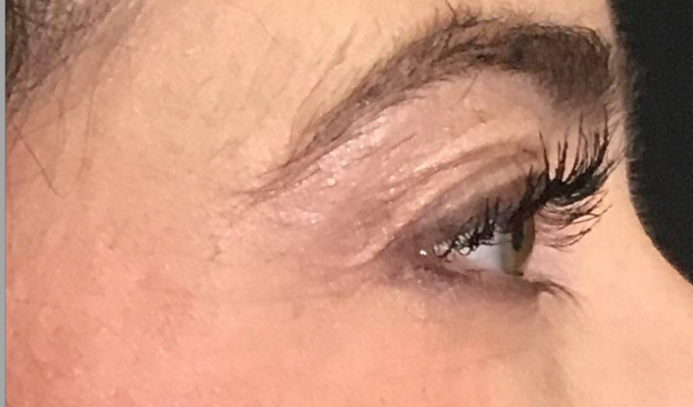 Botox® / Dysport® Case 11 After Image