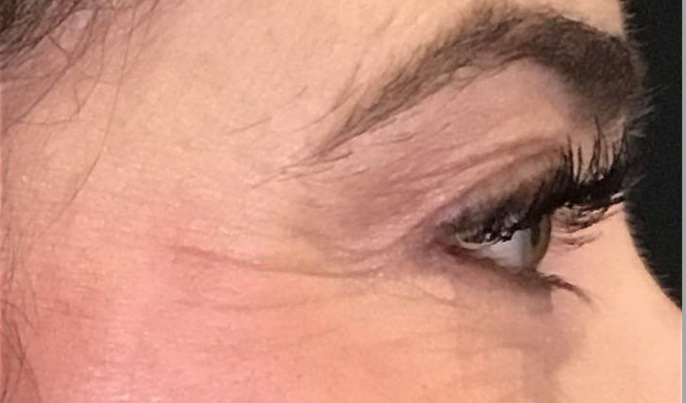 Botox® / Dysport® Case 11 Before Image