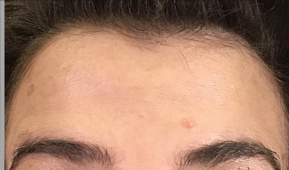 Botox® / Dysport® Case 11 After Image