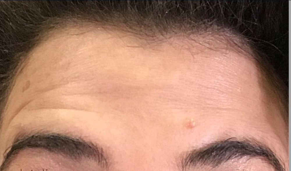 Botox® / Dysport® Case 11 Before Image