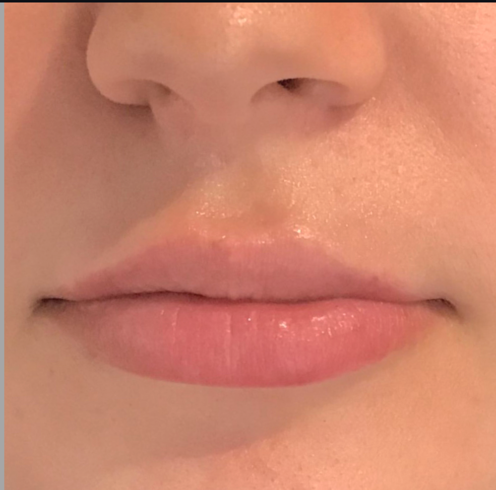 Lip Injections Case 12 After Image