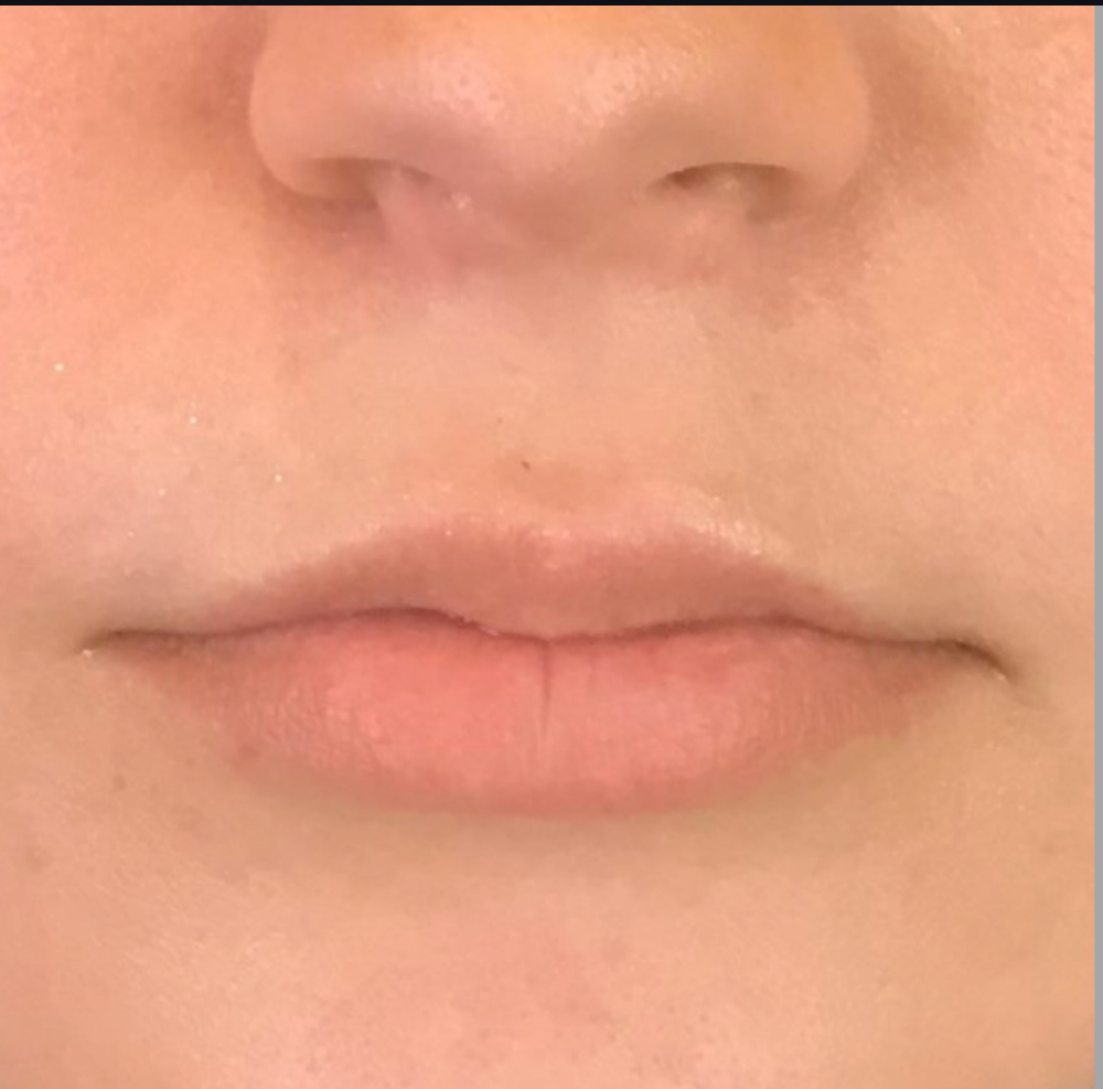Lip Injections Case 12 Before Image