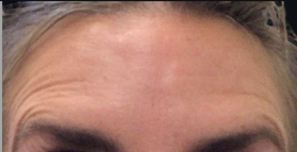 Botox® / Dysport® Case 12 After Image