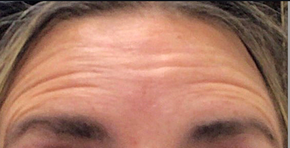 Botox® / Dysport® Case 12 Before Image