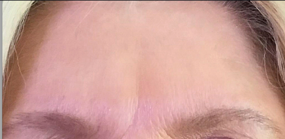 Botox® / Dysport® Case 13 After Image