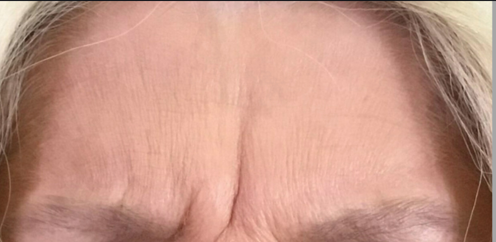 Botox® / Dysport® Case 13 Before Image