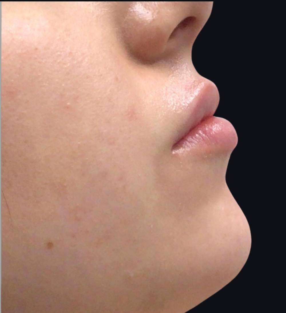 Lip Injections Case 13 After Image