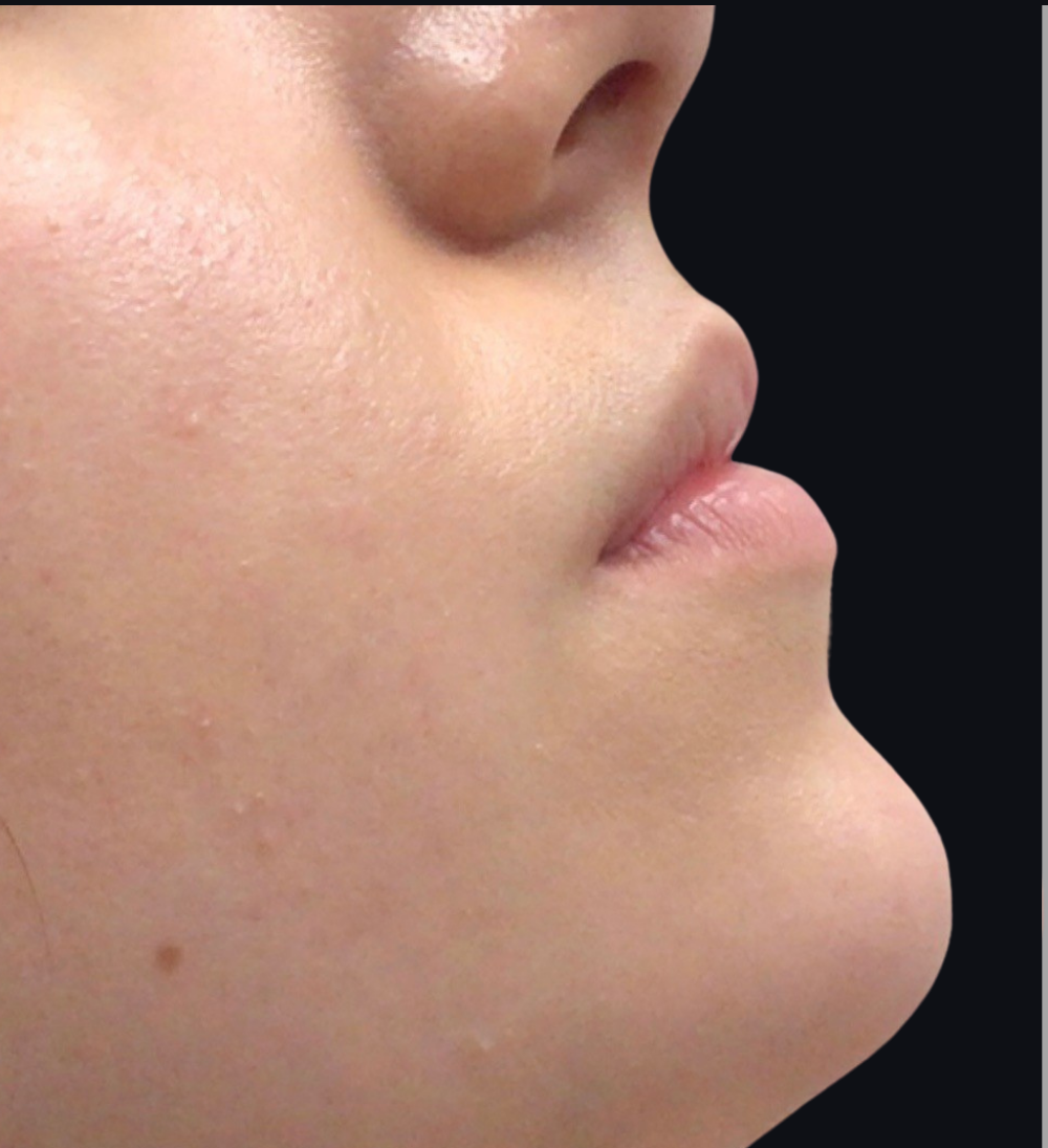 Lip Injections Case 13 Before Image