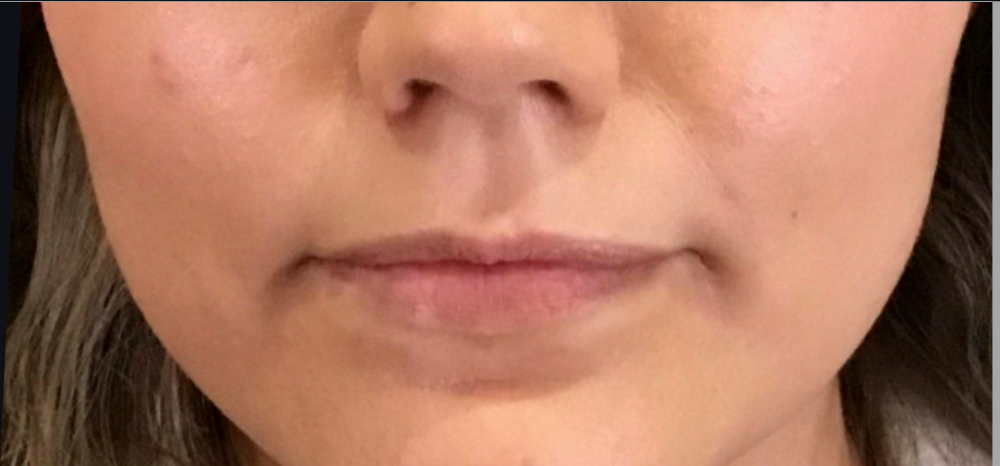 Dermal Fillers Case 13 Before Image