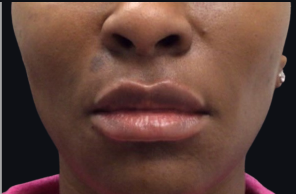 Lip Injections Case 14 After Image