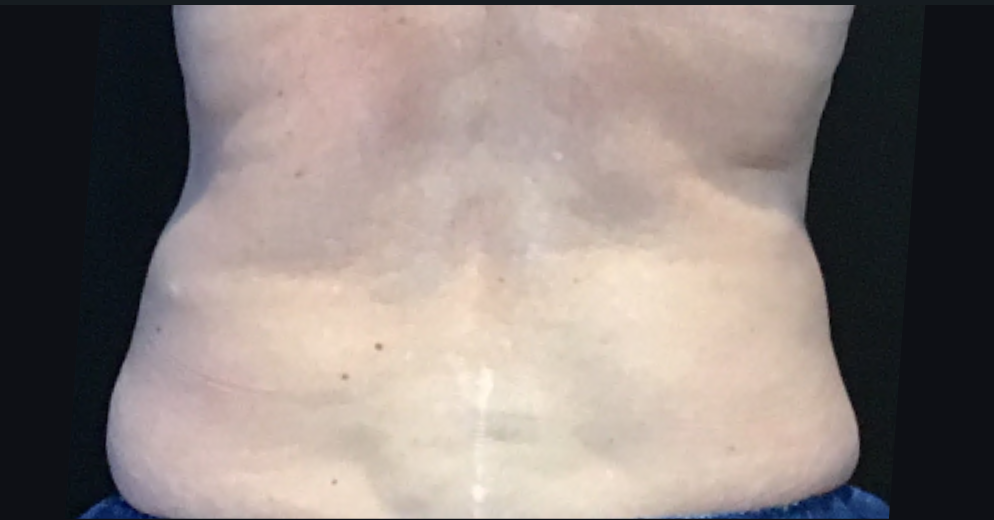 Coolsculpting® ELITE Case 14 After Image