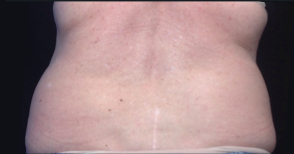 Coolsculpting® ELITE Case 14 Before Image