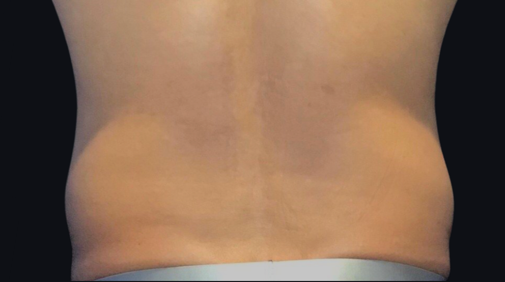 Coolsculpting® ELITE Case 15 After Image