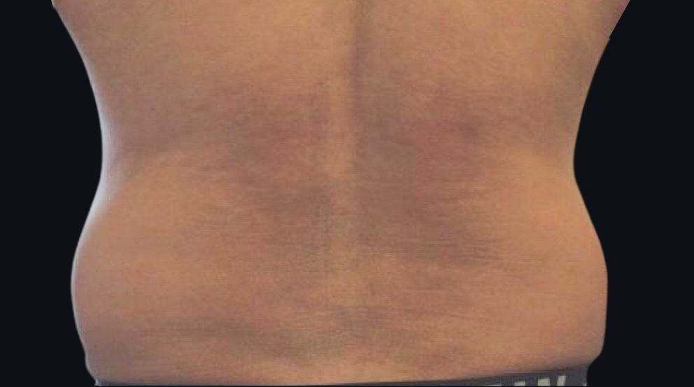 Coolsculpting® ELITE Case 15 Before Image