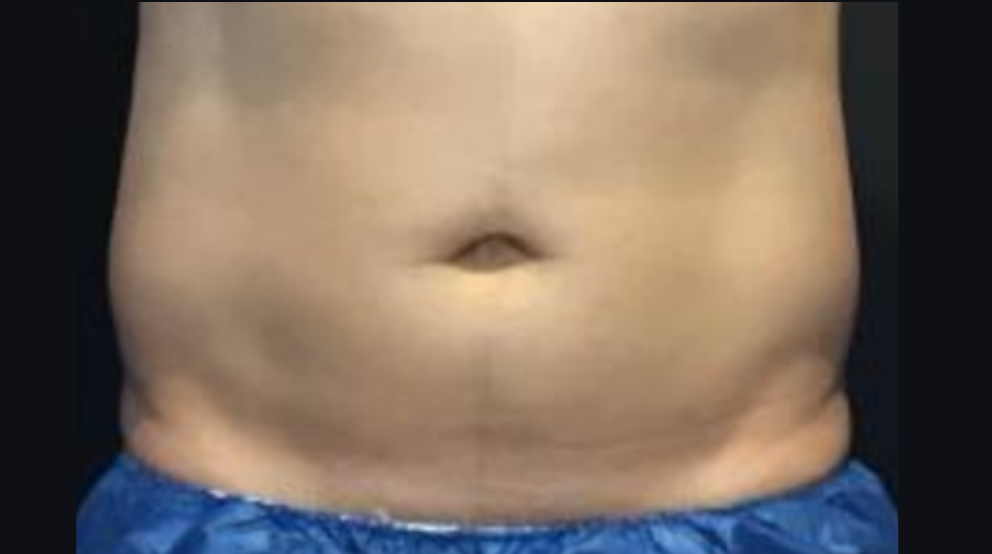 Coolsculpting® ELITE Case 15 After Image