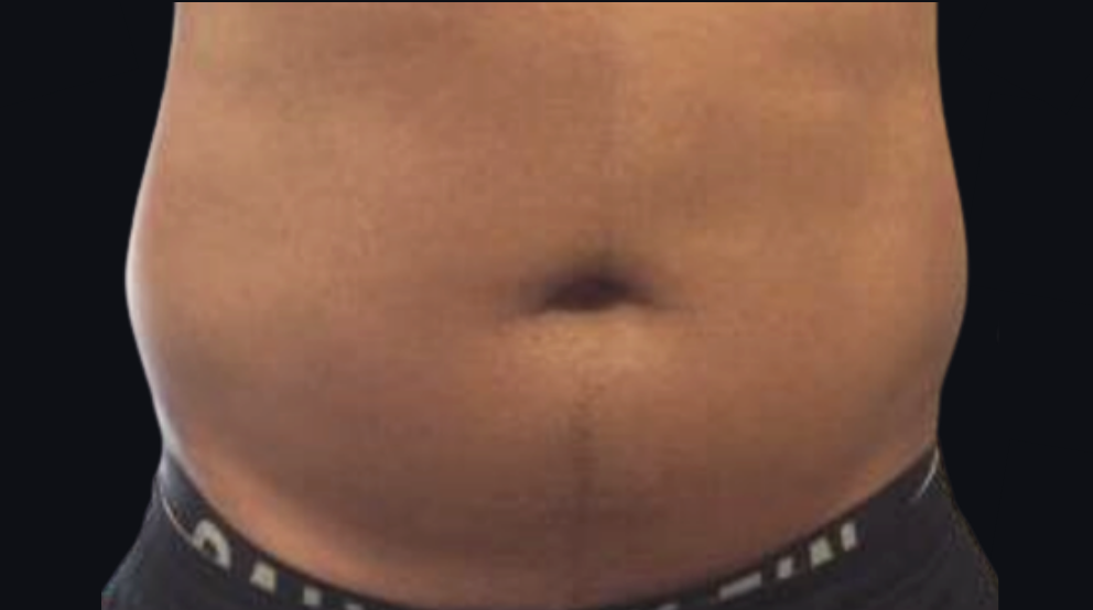 Coolsculpting® ELITE Case 15 Before Image