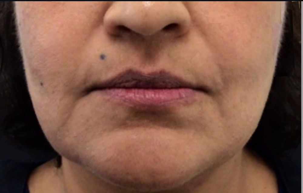 Lip Injections Case 15 Before Image