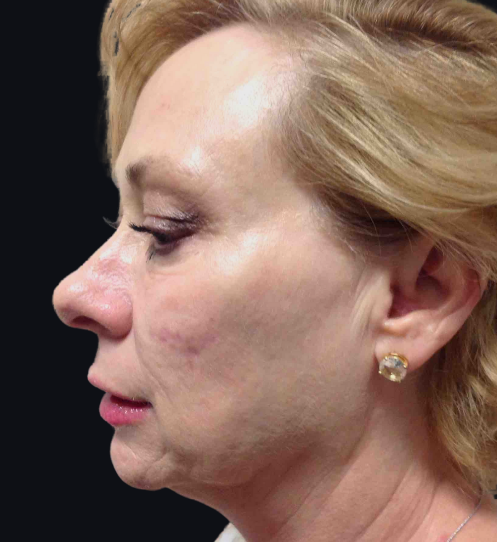 Dermal Fillers Case 15 Before Image