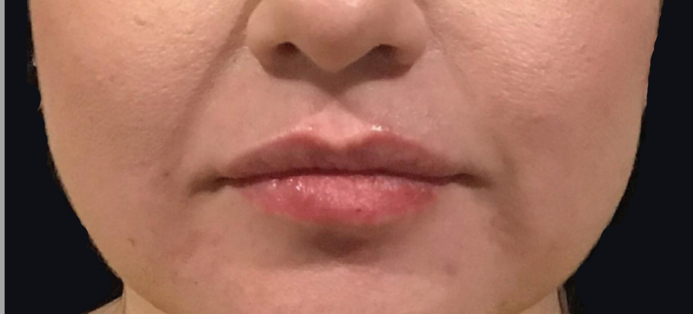 Lip Injections Case 16 After Image