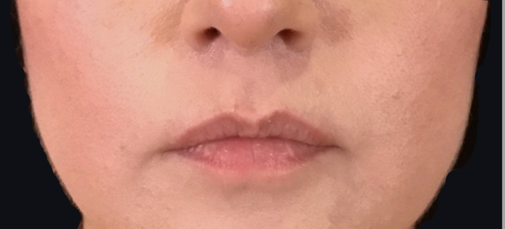 Lip Injections Case 16 Before Image