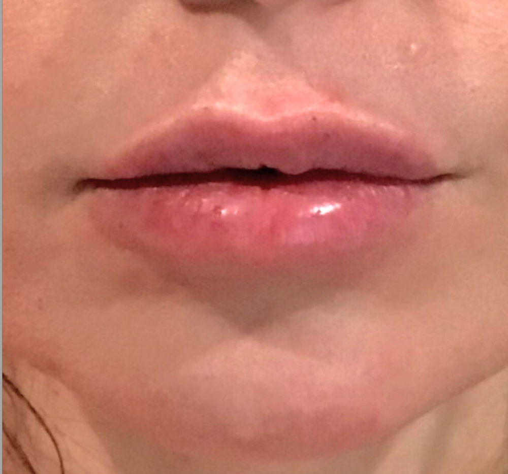 Dermal Fillers Case 16 After Image