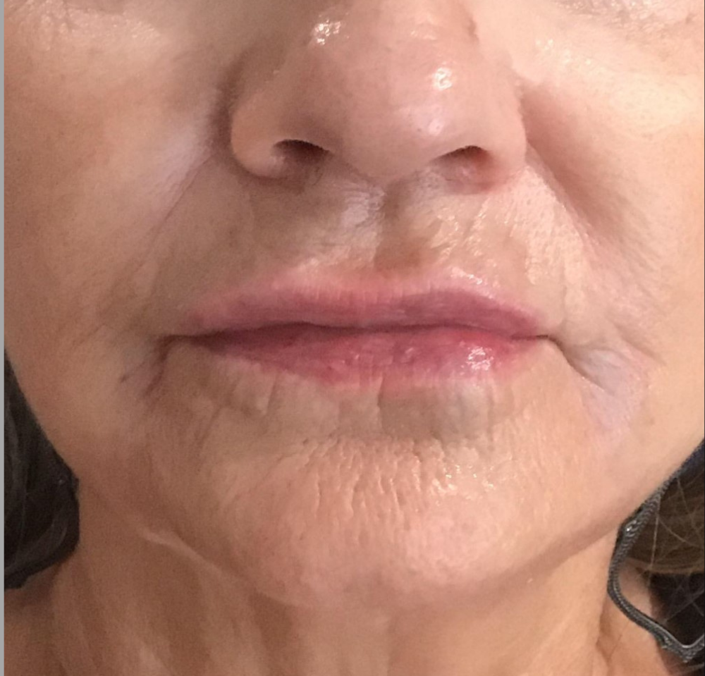 Lip Injections Case 17 After Image
