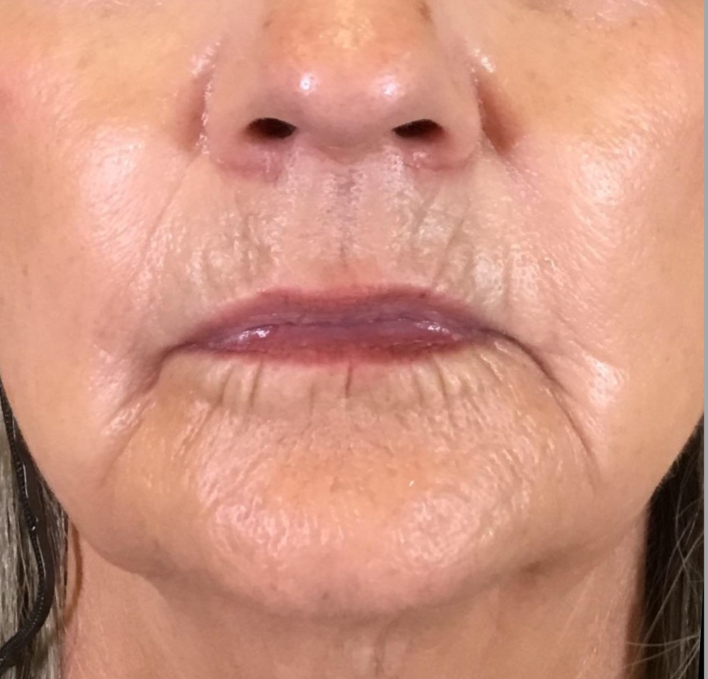 Lip Injections Case 17 Before Image