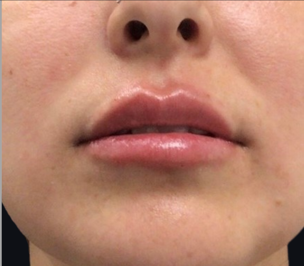 Lip Injections Case 18 After Image