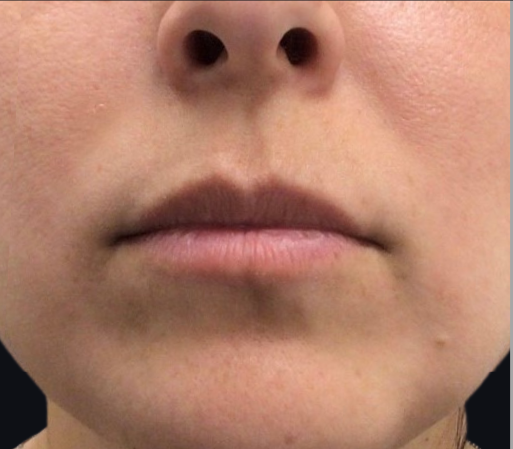 Lip Injections Case 18 Before Image