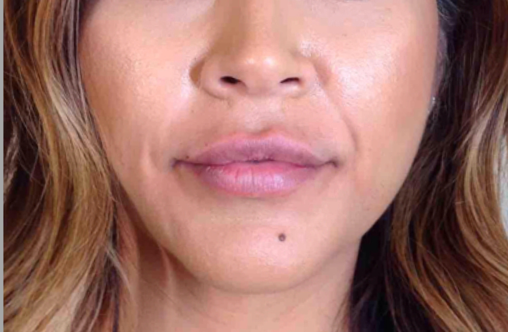 Dermal Fillers Case 18 After Image