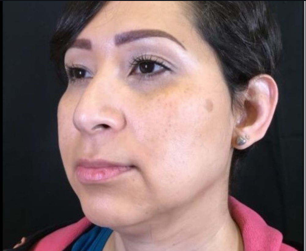Coolsculpting® ELITE Case 19 Before Image