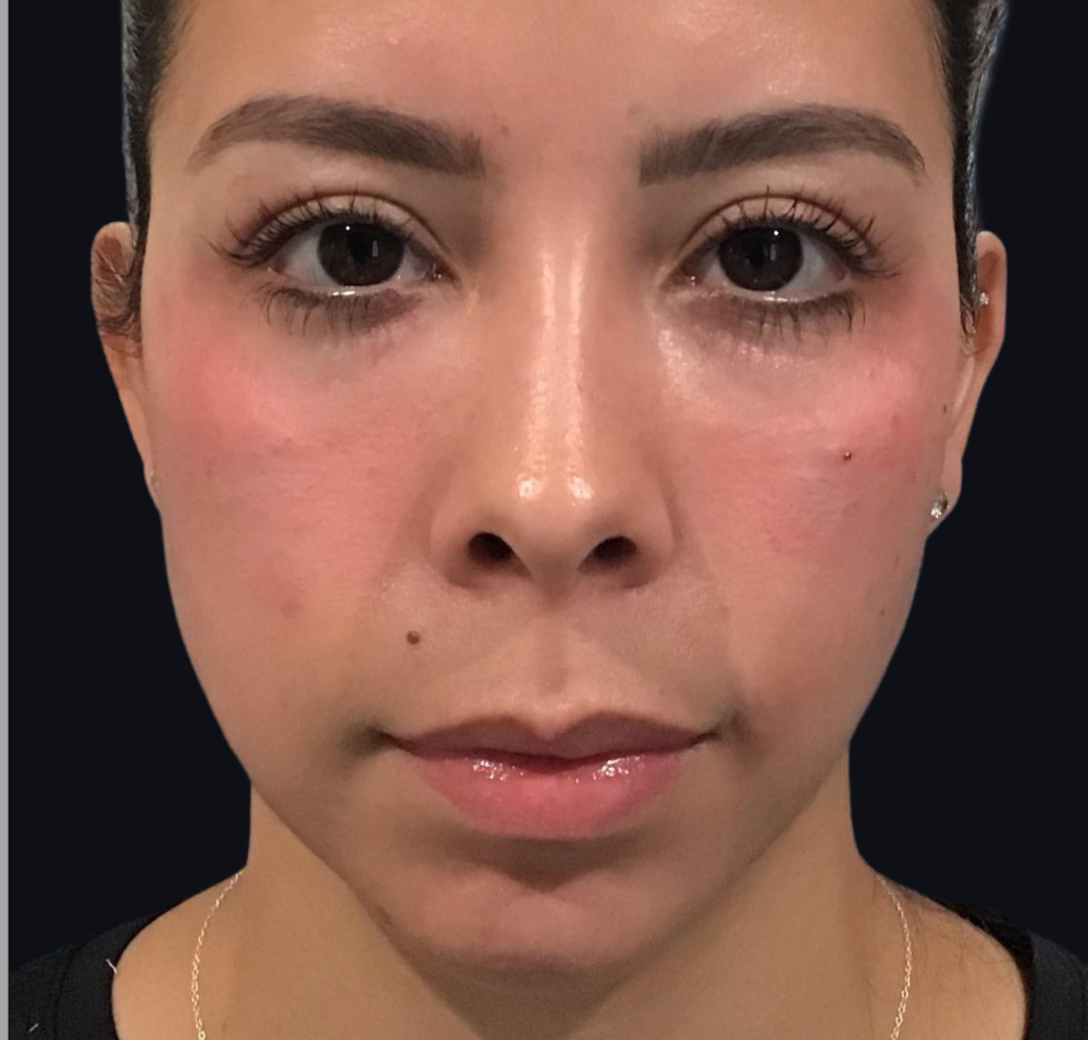 Dermal Fillers Case 19 After Image