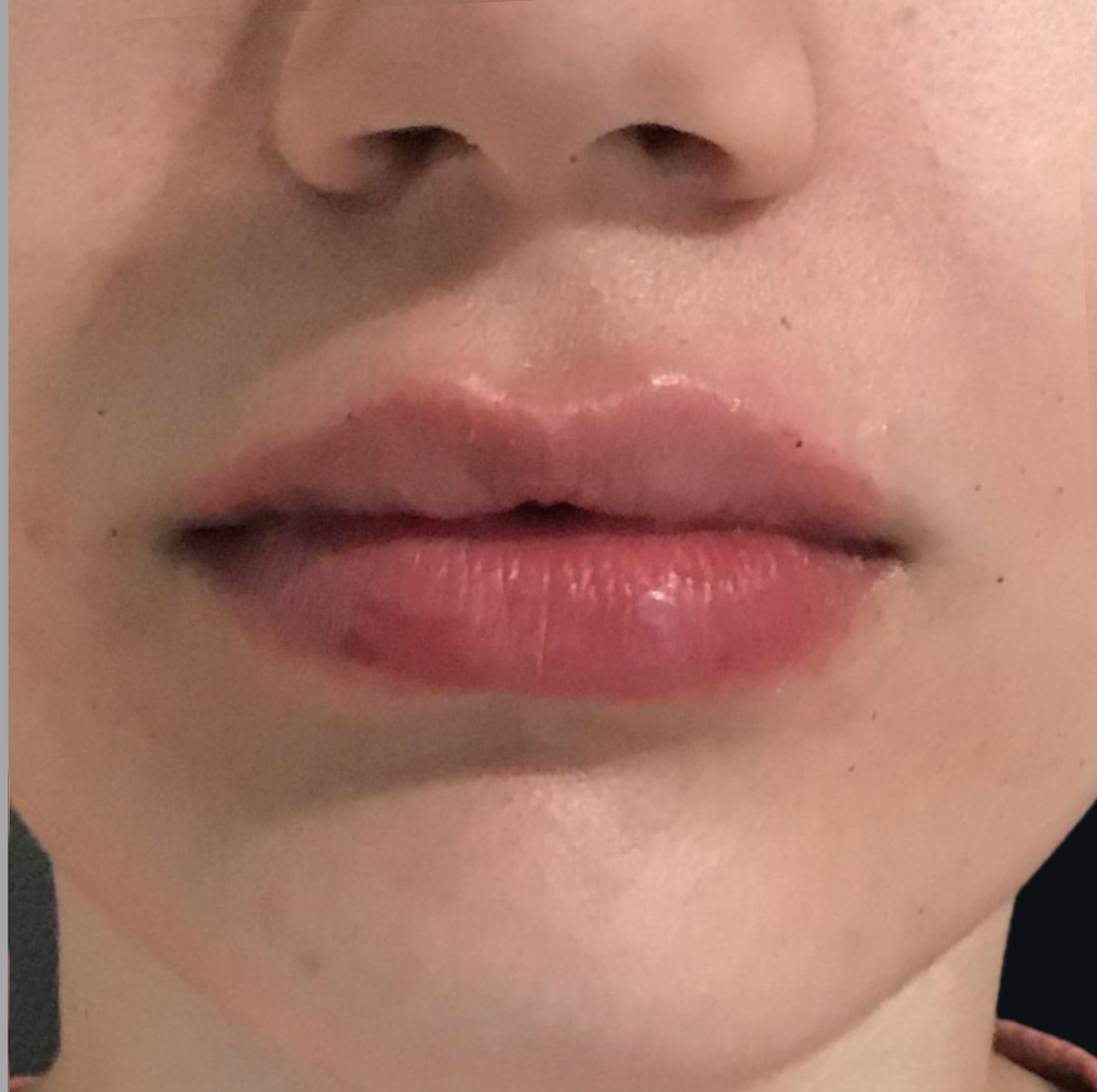 Lip Injections Case 2 After Image