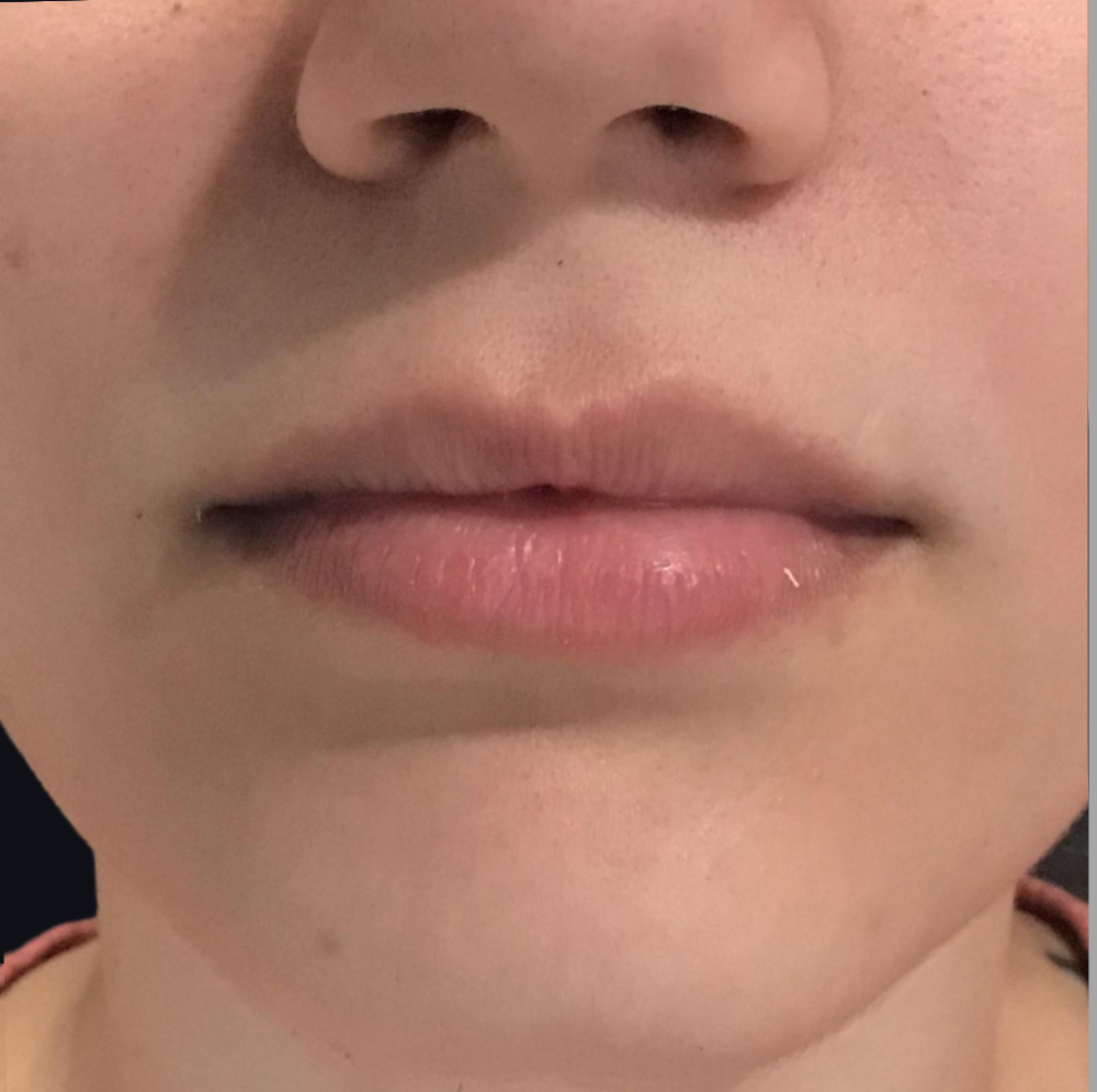 Lip Injections Case 2 Before Image