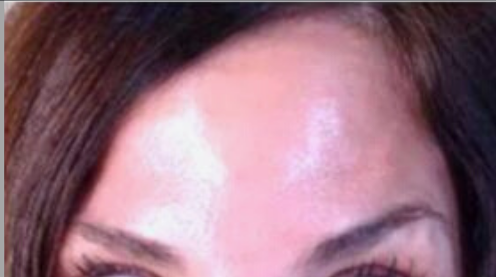 Botox® / Dysport® Case 2 After Image