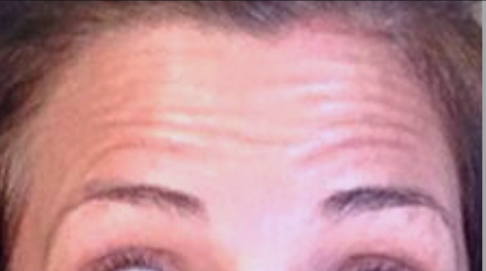 Botox® / Dysport® Case 2 Before Image