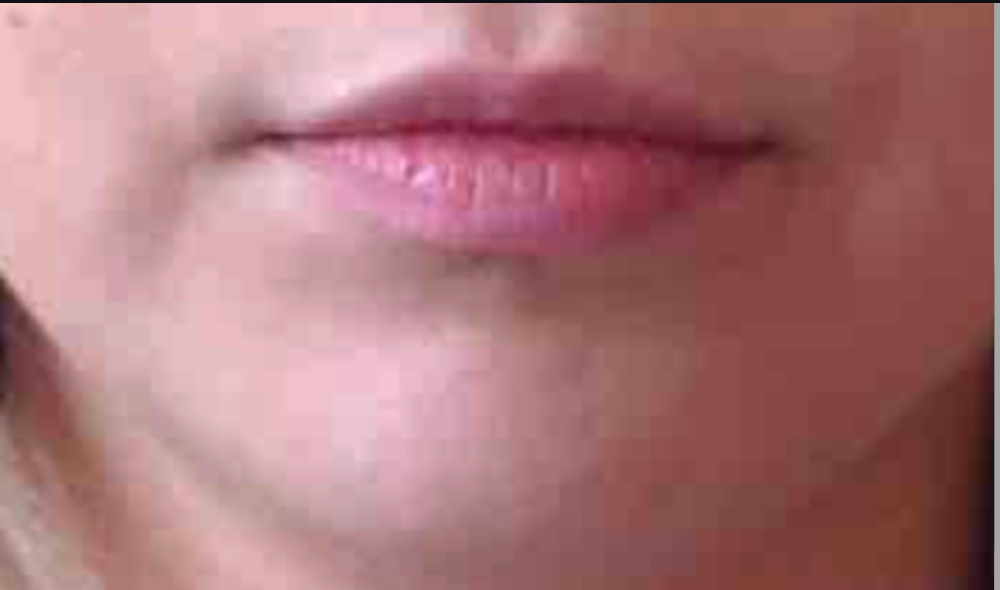 Dermal Fillers Case 2 Before Image