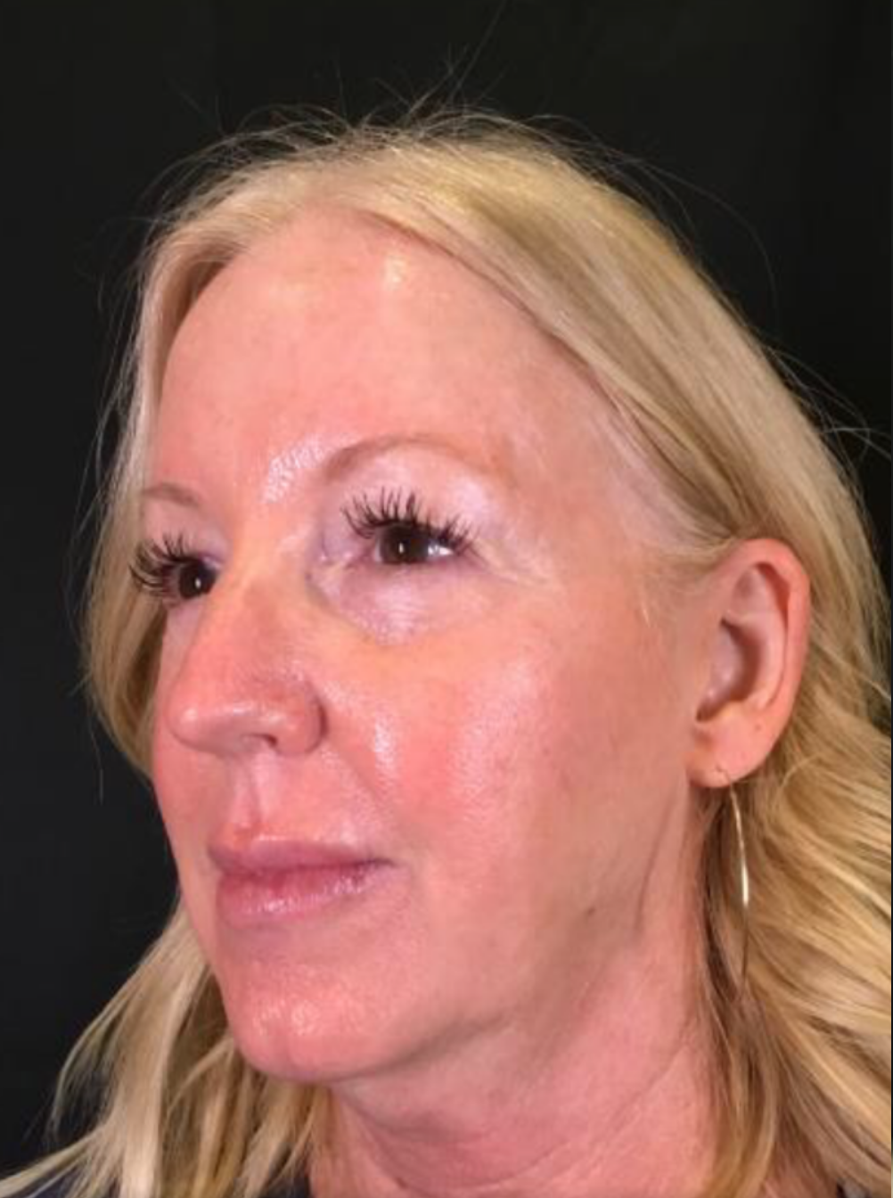 Coolsculpting® ELITE Case 20 Before Image