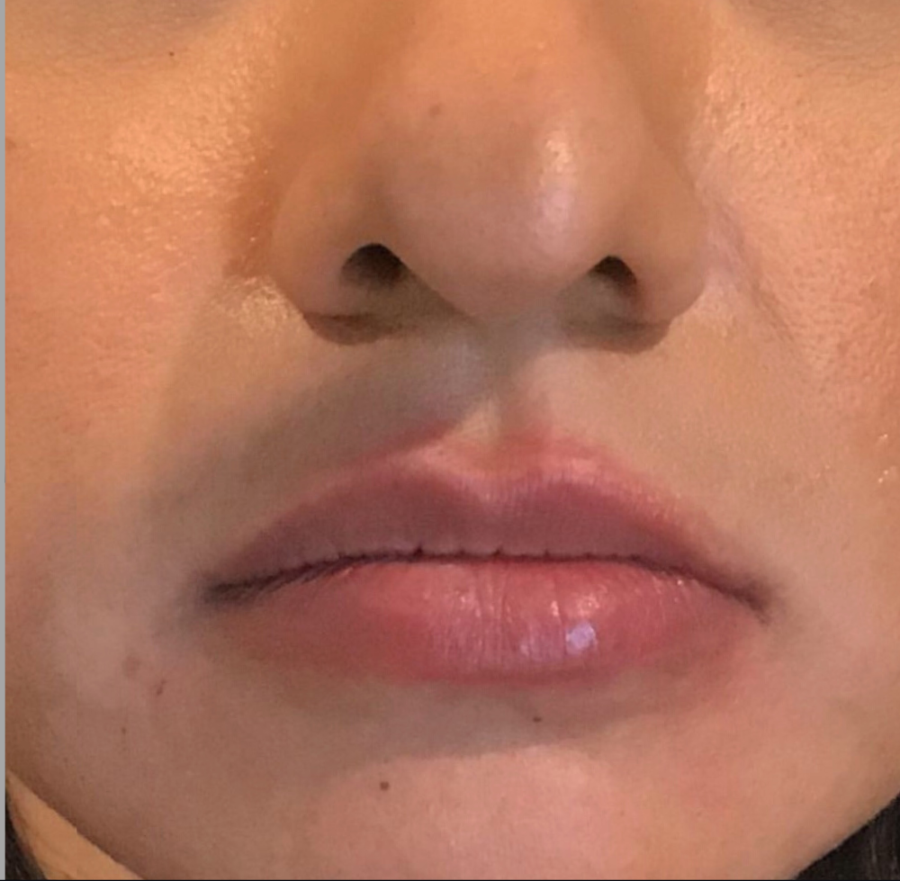 Lip Injections Case 20 After Image