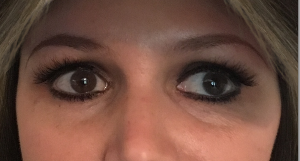 Dermal Fillers Case 20 Before Image