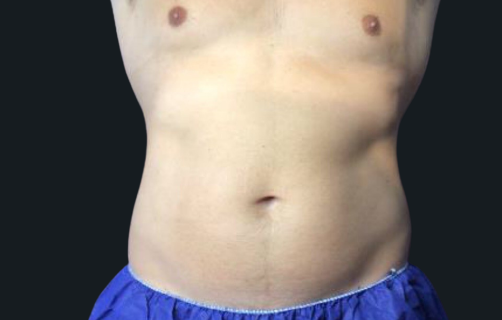 Coolsculpting® ELITE Case 22 After Image